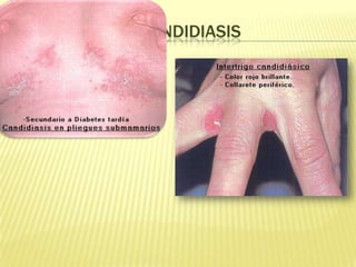 CANDIDIASIS