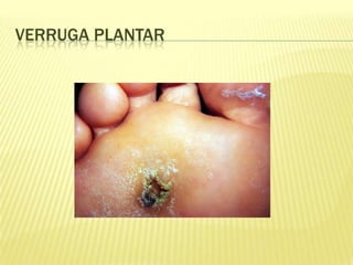 VERRUGA PLANTAR