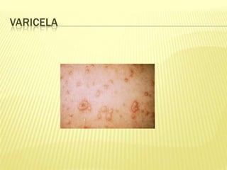 VARICELA
