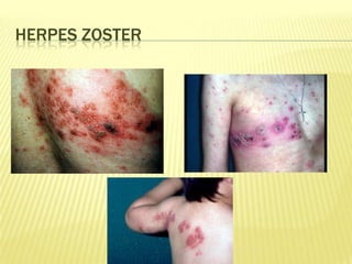 HERPES ZOSTER