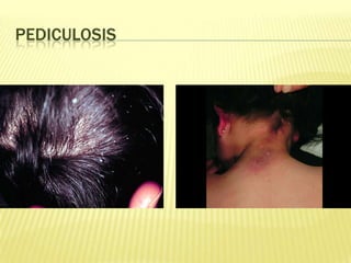 PEDICULOSIS