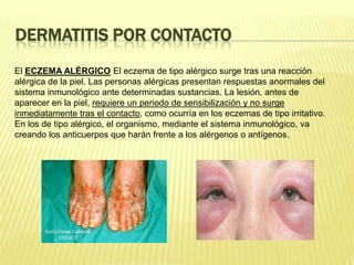 Dermatitis por contactoEl ECZEMA ALÉRGICOEl eczema de tipo alérgico surge tras una reacción alérgica de la piel. Las personas alérgicas presentan respuestas anormales del sistema inmunológico ante determinadas sustancias. La lesión, antes de aparecer en la piel, requiere un periodo de sensibilización y no surge inmediatamente tras el contacto, como ocurría en los eczemas de tipo irritativo. En los de tipo alérgico, el organismo, mediante el sistema inmunológico, va creando los anticuerpos que harán frente a los alérgenos o antígenos.