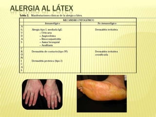 Alergia al látex