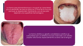 La forma pseudomembranosa o muguet se caracteriza 
por el desarrollo de placas blancas a nivel de la mucosa 
oral que se desprenden fácilmente con el rascado 
dejando una superficie hemorrágica. 
La forma atrófica o glositis candidiásica atrófica se 
caracteriza por un eritema mucoso marcado con atrofia 
papilar afectando especialmente al dorso de la lengua. 
 