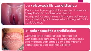 La vulvovaginitis candidiasica 
• Cursa con flujo vaginal blanquecino intenso y a 
la exploración se observan placas 
blanquecinas pseudomembranosas adheridas 
a la pared vaginal semejantes al muguet de la 
cavidad oral. 
La balanopostitis candidiasica 
• Consiste en la infección del glande por 
Cándida, clínicamente se observan lesiones 
eritematosas cubiertas de una membrana 
blanquecina con lesiones satélites. 
 