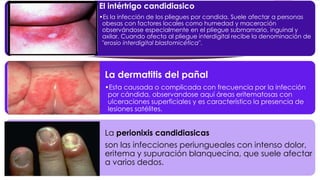 El intértrigo candidiasico 
•Es la infección de los pliegues por candida. Suele afectar a personas 
obesas con factores locales como humedad y maceración 
observándose especialmente en el pliegue submamario, inguinal y 
axilar. Cuando afecta al pliegue interdigital recibe la denominación de 
"erosio interdigital blastomicética". 
La dermatitis del pañal 
•Esta causada o complicada con frecuencia por la infección 
por cándida, observandose aquí áreas eritematosas con 
ulceraciones superficiales y es característico la presencia de 
lesiones satélites. 
La perionixis candidiasicas 
son las infecciones periungueales con intenso dolor, 
eritema y supuración blanquecina, que suele afectar 
a varios dedos. 
 