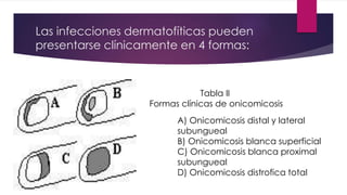 Las infecciones dermatofíticas pueden 
presentarse clínicamente en 4 formas: 
Tabla II 
Formas clínicas de onicomicosis 
A) Onicomicosis distal y lateral 
subungueal 
B) Onicomicosis blanca superficial 
C) Onicomicosis blanca proximal 
subungueal 
D) Onicomicosis distrofica total 
 
