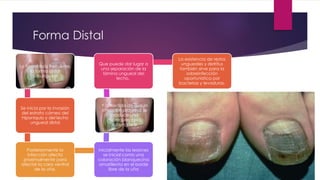 Forma Distal 
La forma más frecuente, 
la forma distal 
subungueal 
Se inicia por la invasión 
del estrato córneo del 
hiponiquio y del lecho 
ungueal distal 
Posteriormente la 
infección afecta 
proximalmente para 
afectar la cara ventral 
de la uña. 
Que puede dar lugar a 
una separación de la 
lámina ungueal del 
lecho. 
Y a medida de que la 
infección progresa se 
produce una 
hiperqueratosis 
subungueal 
Inicialmente las lesiones 
se inicial como una 
coloración blanquecina 
amarillenta en el borde 
libre de la uña 
La existencia de restos 
ungueales y detritus 
también sirve para la 
sobreinfección 
oportunistica por 
bacterias y levaduras. 
 