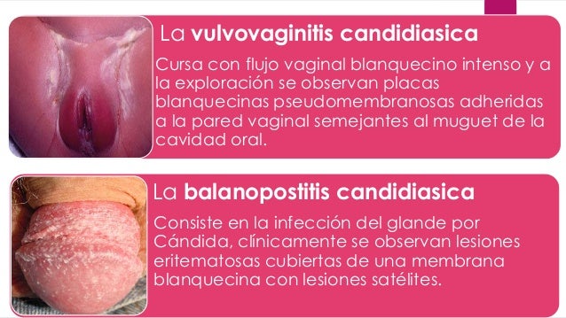 vaginal candidasis-thesis vaginal candidasis-thesis