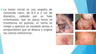  La lesion inicial es una ampolla de
contenido claro, de 0.5 a 2 cm de
diametro, rodeada por un halo
eritematoso, que en pocas horas se
transforma en pustula; el techo se
rompe y aparece un exudado seroso o
seropurulento que se deseca y origina
las costras melicericas.
 