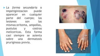  La forma secundaria o
impetiginizacion puede
aparecer en cualquier
parte del cuerpo; las
lesiones son las
mismas:eritema, ampollas,
pustulas y costras
melicericas. Esta forma
casi siempre se asienta
sobre una dermatosis
pruriginosa previa.
 