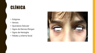 CLÍNICA
• Estigmas.
• Xerosis
• Queratosis folicular
• Signo de Dennie-Morgan
• Signo de Hertoghe
• Palidez y eritema facial
 