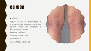 CLÍNICA
• Prurito:
Pápulas o placas eritematosas y
edematosas, en ocaciones vesículas,
muchas veces con exudacion y
formación de costras
Áreas de piel seca
Lesiones por rascado:
Excoriaciones
Liquenificacion (crónico)
 
