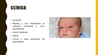 CLÍNICA
• Lactantes:
• Mejillas y cara (respetando el
triángulo nasolabial y zona
periorbitaria)
• Cuero Cabelludo
• Ojeras
• Tronco y caras extensoras de
etremidades.
 