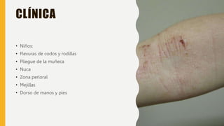 CLÍNICA
• Niños:
• Flexuras de codos y rodillas
• Pliegue de la muñeca
• Nuca
• Zona perioral
• Mejillas
• Dorso de manos y pies
 