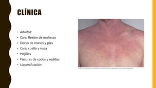 CLÍNICA
• Adultos:
• Cara, flexion de muñecas
• Dorso de manos y pies
• Cara, cuello y nuca
• Mejillas
• Flexuras de codos y rodillas
• Liquenificación
 