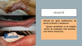 CELULITE
• Infecção em geral estafilocócica da
derme profunda e hipoderme.
• Quadro semelhante ao da erisipela,
porém de localização mais profunda,
com limites imprecisos.
 