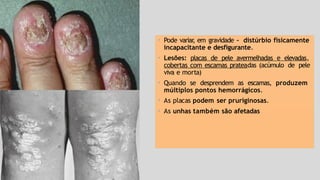 • Pode variar
, em gravidade – distúrbio fisicamente
incapacitante e desfigurante.
• Lesões: placas de pele avermelhadas e elevadas,
cobertas com escamas prateadas (acúmulo de pele
viva e morta)
• Quando se desprendem as escamas, produzem
múltiplos pontos hemorrágicos.
• As placas podem ser pruriginosas.
• As unhas também são afetadas
 