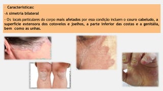 • Características:
-A simetria bilateral
- Os locais particulares do corpo mais afetados por essa condição incluem o couro cabeludo, a
superfície extensora dos cotovelos e joelhos, a parte inferior das costas e a genitália,
bem como as unhas.
 
