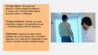 • Terapia tópica: Utilizado para
diminuir a hiperatividade da epiderme.
A terapia com corticosteroides tópicos
atua para reduzir a inflamação;
• Terapia sistêmica: Indicado nos casos
moderados e graves e nos pacientes em que
o tratamento tópico não foi responsivo;
• Fototerapia: Exposição da pele a fontes
artificiais de luz ultravioleta (UV) em sessões
regulares, com doses de UV adequadas a cada
doente e durante períodos predeterminados.
 