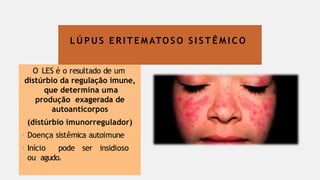L Ú P U S E RI T E M ATO S O S I S T Ê M I C O
O LES é o resultado de um
distúrbio da regulação imune,
que determina uma
produção exagerada de
autoanticorpos
(distúrbio imunorregulador)
• Doença sistêmica autoimune
• Início pode ser insidioso
ou agudo.
 