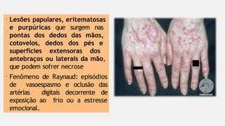 • Lesões papulares, eritematosas
e purpúricas que surgem nas
pontas dos dedos das mãos,
cotovelos, dedos dos pés e
superfícies extensoras dos
antebraços ou laterais da mão,
que podem sofrer necrose
• Fenômeno de Raynaud: episódios
de vasoespasmo e oclusão das
artérias digitais decorrente de
exposição ao frio ou a estresse
emocional.
 