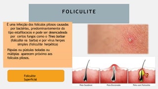 FOLI C ULI T E
É uma infecção dos folículos pilosos causadas
por bactérias, predominantemente do
tipo estafilococos e pode ser desencadeada
por certos fungos como o Tinea barbae
(foliculite na barba) e por vírus herpes
simples (foliculite herpética)
• Pápulas ou pústulas isoladas ou
múltiplas aparecem próximo aos
folículos pilosos.
Foliculite
Superficial
 