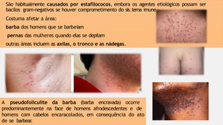 • São habitualmente causados por estafilococos, embora os agentes etiológicos possam ser
bacilos gram-negativos se houver comprometimento do sis.tema imune
• Costuma afetar a área:
- barba dos homens que se barbeiam
- pernas das mulheres quando elas se depilam
- outras áreas incluem as axilas, o tronco e as nádegas.
A pseudofoliculite da barba (barba encravada) ocorre
predominantemente na face de homens afrodescedentes e de
homens com cabelos encaracolados, em consequência do ato
de se barbear
.
 