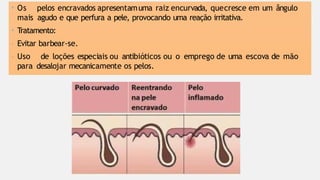 • Os pelos encravados apresentamuma raiz encurvada, quecresce em um ângulo
mais agudo e que perfura a pele, provocando uma reação irritativa.
• Tratamento:
- Evitar barbear-se.
- Uso de loções especiais ou antibióticos ou o emprego de uma escova de mão
para desalojar mecanicamente os pelos.
 