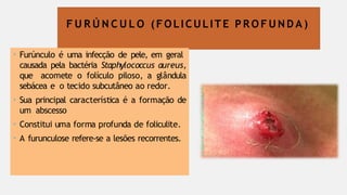 F U R Ú N C U L O (FOLICULITE P R O F U N D A )
• Furúnculo é uma infecção de pele, em geral
causada pela bactéria Staphylococcus aureus,
que acomete o folículo piloso, a glândula
sebácea e o tecido subcutâneo ao redor.
• Sua principal característica é a formação de
um abscesso
• Constitui uma forma profunda de foliculite.
• A furunculose refere-se a lesões recorrentes.
 