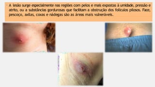 • A lesão surge especialmente nas regiões com pelos e mais expostas à umidade, pressão e
atrito, ou a substâncias gordurosas que facilitam a obstrução dos folículos pilosos. Face,
pescoço, axilas, coxas e nádegas são as áreas mais vulneráveis.
 