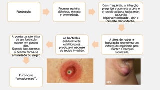 Furúnculo
Pequena espinha
dolorosa, elevada
e avermelhada.
Com frequência, a infecção
progride e acomete a pele e
o tecido adiposo subjacente,
causando
hipersensibilidade, dor e
celulite circundante.
A área de rubor e
induração representa um
esforço do organismo para
manter a infecção
localizada.
As bactérias
(habitualmente
estafilococos)
produzem necrose
do tecido invadido.
A ponta característica
de um furúnculo
ocorre em poucos
dias.
Quando isso acontece,
o centro torna-se
amarelado ou negro
Furúnculo
“amadureceu”.
 