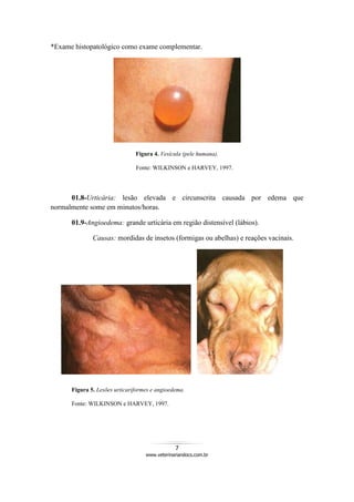 7
www.veterinariandocs.com.br
*Exame histopatológico como exame complementar.
Figura 4. Vesícula (pele humana).
Fonte: WILKINSON e HARVEY, 1997.
01.8-Urticária: lesão elevada e circunscrita causada por edema que
normalmente some em minutos/horas.
01.9-Angioedema: grande urticária em região distensível (lábios).
Causas: mordidas de insetos (formigas ou abelhas) e reações vacinais.
Figura 5. Lesões urticariformes e angioedema.
Fonte: WILKINSON e HARVEY, 1997.
 