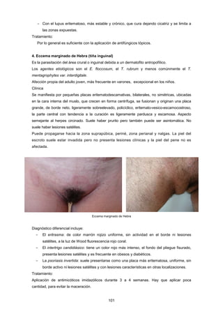 ­ Con el lupus eritematoso, más estable y crónico, que cura dejando cicatriz y se limita a
las zonas expuestas.
Tratamiento:
Por lo general es suficiente con la aplicación de antifúngicos tópicos.
4. Eccema marginado de Hebra (tiña inguinal)
Es la parasitación del área crural o inguinal debida a un dermatofito antropofílico.
Los agentes etiológicos son el E. floccosum, el T. rubrum y menos comúnmente el T.
mentagrophytes var. interdigitale.
Afección propia del adulto joven, más frecuente en varones, excepcional en los niños.
Clínica
Se manifiesta por pequeñas placas eritematodescamativas, bilaterales, no simétricas, ubicadas
en la cara interna del muslo, que crecen en forma centrífuga, se fusionan y originan una placa
grande, de borde neto, ligeramente sobreelevado, policíclico, eritemato-vesico-escamocostroso,
la parte central con tendencia a la curación es ligeramente pardusca y escamosa. Aspecto
semejante al herpes circinado. Suele haber prurito pero también puede ser asintomática. No
suele haber lesiones satélites.
Puede propagarse hacia la zona suprapúbica, periné, zona perianal y nalgas. La piel del
escroto suele estar invadida pero no presenta lesiones clínicas y la piel del pene no es
afectada.
Eccema marginado de Hebra
Diagnóstico diferencial incluye:
­ El eritrasma: de color marrón rojizo uniforme, sin actividad en el borde ni lesiones
satélites, a la luz de Wood fluorescencia rojo coral.
­ El intertrigo candidiásico: tiene un color rojo más intenso, el fondo del pliegue fisurado,
presenta lesiones satélites y es frecuente en obesos y diabéticos.
­ La psoriasis invertida: suele presentarse como una placa más eritematosa, uniforme, sin
borde activo ni lesiones satélites y con lesiones características en otras localizaciones.
Tratamiento:
Aplicación de antimicóticos imidazólicos durante 3 a 4 semanas. Hay que aplicar poca
cantidad, para evitar la maceración.
101
 