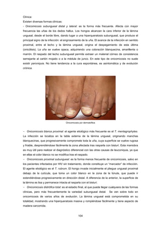 Clínica:
Existen diversas formas clínicas:
- Onicomicosis subungueal distal y lateral: es la forma más frecuente. Afecta con mayor
frecuencia las uñas de los dedos hallux. Los hongos alcanzan la cara inferior de la lámina
ungueal, desde el borde libre, dando lugar a una hiperqueratosis subungueal, que produce el
principal signo de la infección: el engrosamiento de la uña. El avance de la infección en sentido
proximal, entre el lecho y la lámina ungueal, origina el despegamiento de esta última
(onicólisis). La uña se vuelve opaca, adquiriendo una coloración blanquecina, amarillenta o
marrón. El raspado del lecho subungueal permite extraer un material córneo de consistencia
semejante al cartón mojado o a la médula de junco. En este tipo de onicomicosis no suele
existir paroniquia. No tiene tendencia a la cura espontánea, es asintomática y de evolución
crónica.
Onicomicosis por dermatofitos
- Onicomicosis blanca proximal: el agente etiológico más frecuente es el T. mentagrophytes.
La infección se localiza en la tabla externa de la lámina ungueal, originando manchas
blanquecinas, que progresivamente compromete toda la uña, cuya superficie se vuelve rugosa
y friable, desprendiéndose fácilmente la zona afectada tras rasparla con bisturí. Esta maniobra
es muy útil para realizar el diagnóstico diferencial con las otras causas de leuconiquia, ya que
en ellas el color blanco no se modifica tras el raspado.
- Onicomicosis proximal subungueal: es la forma menos frecuente de onicomicosis, salvo en
los pacientes infectados por HIV sin tratamiento, donde constituye un “marcador” de infección.
El agente etiológico es el T. rubrum. El hongo invade inicialmente el pliegue ungueal proximal
debajo de la cutícula, que toma un color blanco en la zona de la lúnula, que puede ir
extendiéndose progresivamente en dirección distal. A diferencia de la anterior, la superficie de
la lámina es lisa y permanece intacta al rasparla con el bisturí.
- Onicomicosis distrófica total: es el estadio final, al que puede llegar cualquiera de las formas
clínicas, pero más frecuentemente la variedad subungueal distal. Se ven sobre todo en
onicomicosis de varios años de evolución. La lámina ungueal está comprometida en su
totalidad, mostrando una hiperqueratosis masiva y rompiéndose fácilmente y tiene aspecto de
madera carcomida.
104
 