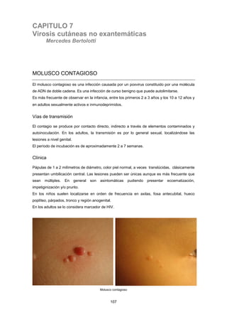 CAPITULO 7
Virosis cutáneas no exantemáticas
Mercedes Bertolotti
MOLUSCO CONTAGIOSO
El molusco contagioso es una infección causada por un poxvirus constituido por una molécula
de ADN de doble cadena. Es una infección de curso benigno que puede autolimitarse.
Es más frecuente de observar en la infancia, entre los primeros 2 a 3 años y los 10 a 12 años y
en adultos sexualmente activos e inmunodeprimidos.
Vías de transmisión
El contagio se produce por contacto directo, indirecto a través de elementos contaminados y
autoinoculación. En los adultos, la transmisión es por lo general sexual, localizándose las
lesiones a nivel genital.
El período de incubación es de aproximadamente 2 a 7 semanas.
Clínica
Pápulas de 1 a 2 milímetros de diámetro, color piel normal, a veces translúcidas, clásicamente
presentan umbilicación central. Las lesiones pueden ser únicas aunque es más frecuente que
sean múltiples. En general son asintomáticas pudiendo presentar eccematización,
impetiginización y/o prurito.
En los niños suelen localizarse en orden de frecuencia en axilas, fosa antecubital, hueco
poplíteo, párpados, tronco y región anogenital.
En los adultos se lo considera marcador de HIV.
Molusco contagioso
107
 