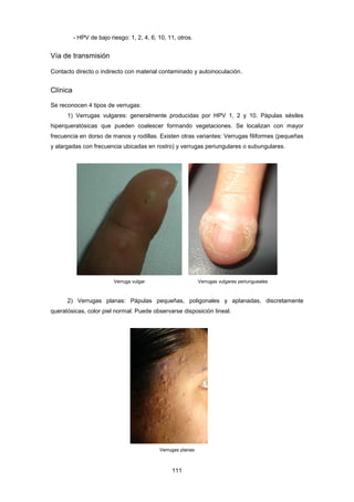 - HPV de bajo riesgo: 1, 2, 4, 6, 10, 11, otros.
Vía de transmisión
Contacto directo o indirecto con material contaminado y autoinoculación.
Clínica
Se reconocen 4 tipos de verrugas:
1) Verrugas vulgares: generalmente producidas por HPV 1, 2 y 10. Pápulas sésiles
hiperqueratósicas que pueden coalescer formando vegetaciones. Se localizan con mayor
frecuencia en dorso de manos y rodillas. Existen otras variantes: Verrugas filiformes (pequeñas
y alargadas con frecuencia ubicadas en rostro) y verrugas periungulares o subungulares.
Verruga vulgar Verrugas vulgares periungueales
2) Verrugas planas: Pápulas pequeñas, poligonales y aplanadas, discretamente
queratósicas, color piel normal. Puede observarse disposición lineal.
Verrugas planas
111
 