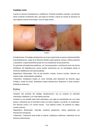 Impétigo mixto
Cuando se asocian el estreptococo y estafilococo. Presenta ampollas y pústulas. Las lesiones
tienen contenido inicialmente claro, que luego se enturbia, cuando se rompen la secreción se
seca dejando costras amarronadas. Cura sin dejar cicatriz.
Impétigo
Complicaciones: El impétigo estreptocócico es el que mayormente se asocia a glomerulonefritis
post-estreptocócica. Luego de la infección también puede aparecer urticaria, eritema polimorfo
y escarlatina. La glomerulonefritis puede ser una complicación de las piodermitis.
En pacientes principalmente pediátricos, con inmunosupresión o insuficiencia renal, las toxinas
exfoliativas del Staphilococcus aureus pueden diseminarse por vía hematógena dando el
Síndrome estafilocócico de la piel escaldada.
Diagnósticos diferenciales: Tiña de piel lampiña, varicela, eccema numular, infección por
herpes simple, enfermedades ampollares.
Tratamiento: Antisépticos locales en curas húmedas para descostrar las lesiones (agua
D´Alibour, borato de sodio). Antibióticos locales (Gentamicina, Mupirocina o Acido fusídico).
Antibióticos sistémicos.
Ectima
Variedad más profunda del impétigo estreptocóccico, que se presenta en pacientes
malnutridos, diabéticos o con mala higiene personal.
Consiste en una ampolla sobre base eritematosa, que luego es reemplazada por una costra
gruesa y adherente que al removerla revela una úlcera irregular y purulenta, en sacabocado.
Son lesiones únicas o en número escaso. Cura dejando cicatriz. Se presenta en nalgas,
muslos y piernas.
Diagnósticos diferenciales: Vasculitis, pioderma gangrenoso, ectima gangrenoso por
Pseudomona aeruginosa.
Tratamiento: Tratamiento local similar al anterior, antibióticos sistémicos, tratamiento de los
factores condicionantes.
116
 