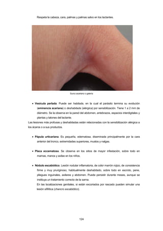 Respeta la cabeza, cara, palmas y palmas salvo en los lactantes.
Surco acariano o galería
• Vesícula perlada. Puede ser habitada, en la cual el parásito termina su evolución
(eminencia acariana) o deshabitada (alérgica) por sensibilización. Tiene 1 a 2 mm de
diámetro. Se la observa en la pared del abdomen, antebrazos, espacios interdigitales y
plantas y talones del lactante.
Las lesiones más profusas y deshabitadas están relacionadas con la sensibilización alérgica a
los ácaros o a sus productos.
• Pápula urticariana. Es pequeña, edematosa, diseminada principalmente por la cara
anterior del tronco, extremidades superiores, muslos y nalgas.
• Placa eccematosa. Se observa en los sitios de mayor infestación, sobre todo en
mamas, manos y axilas en los niños.
• Nódulo escabiótico. Lesión nodular inflamatoria, de color marrón rojizo, de consistencia
firme y muy pruriginoso, habitualmente deshabitado, sobre todo en escroto, pene,
pliegues inguinales, axilares y abdomen. Puede persistir durante meses, aunque se
instituya un tratamiento correcto de la sarna.
En las localizaciones genitales, si están excoriados por rascado pueden simular una
lesión sifilítica (chancro escabiótico).
124
 