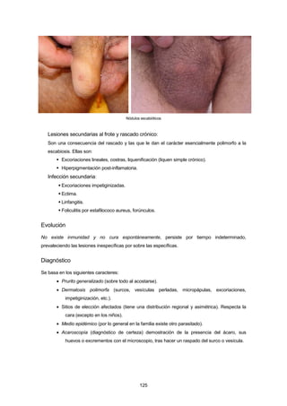 Nódulos escabióticos
Lesiones secundarias al frote y rascado crónico:
Son una consecuencia del rascado y las que le dan el carácter esencialmente polimorfo a la
escabiosis. Ellas son:
 Excoriaciones lineales, costras, liquenificación (liquen simple crónico).
 Hiperpigmentación post-inflamatoria.
Infección secundaria:
 Excoriaciones impetiginizadas.
 Ectima.
 Linfangitis.
 Foliculitis por estafilococo aureus, forúnculos.
Evolución
No existe inmunidad y no cura espontáneamente, persiste por tiempo indeterminado,
prevaleciendo las lesiones inespecíficas por sobre las específicas.
Diagnóstico
Se basa en los siguientes caracteres:
• Prurito generalizado (sobre todo al acostarse).
• Dermatosis polimorfa (surcos, vesículas perladas, micropápulas, excoriaciones,
impetiginización, etc.).
• Sitios de elección afectados (tiene una distribución regional y asimétrica). Respecta la
cara (excepto en los niños).
• Medio epidémico (por lo general en la familia existe otro parasitado).
• Acaroscopía (diagnóstico de certeza) demostración de la presencia del ácaro, sus
huevos o excrementos con el microscopio, tras hacer un raspado del surco o vesícula.
125
 