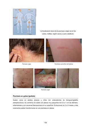 La localización típica de la psoriasis vulgar es en los
codos, rodillas, región sacra y cuero cabelludo.
Psoriasis vulgar Fenómeno isomórfico de Koebner
Psoriasis vulgar
Psoriasis en gotas (guttata)
Suelen verse en adultos jóvenes y niños con antecedentes de faringoamigdalitis
estreptoccócica. Su comienzo es súbito con placas muy pequeñas de 0,5 a 1 cm de diámetro,
eritematosas y con escamas blanquecinas en su superficie. Evolucionan en 2 a 3 meses y más
raramente pueden transformarse en una psoriasis en placas.
136
 