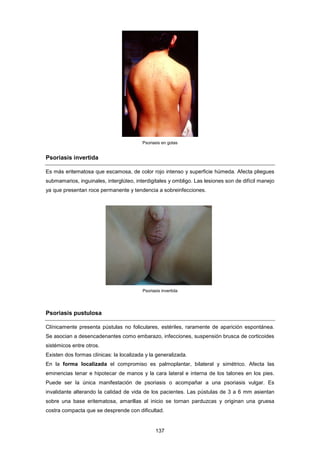 Psoriasis en gotas
Psoriasis invertida
Es más eritematosa que escamosa, de color rojo intenso y superficie húmeda. Afecta pliegues
submamarios, inguinales, interglúteo, interdigitales y ombligo. Las lesiones son de difícil manejo
ya que presentan roce permanente y tendencia a sobreinfecciones.
Psoriasis invertida
Psoriasis pustulosa
Clínicamente presenta pústulas no foliculares, estériles, raramente de aparición espontánea.
Se asocian a desencadenantes como embarazo, infecciones, suspensión brusca de corticoides
sistémicos entre otros.
Existen dos formas clínicas: la localizada y la generalizada.
En la forma localizada el compromiso es palmoplantar, bilateral y simétrico. Afecta las
eminencias tenar e hipotecar de manos y la cara lateral e interna de los talones en los pies.
Puede ser la única manifestación de psoriasis o acompañar a una psoriasis vulgar. Es
invalidante alterando la calidad de vida de los pacientes. Las pústulas de 3 a 6 mm asientan
sobre una base eritematosa, amarillas al inicio se tornan parduzcas y originan una gruesa
costra compacta que se desprende con dificultad.
137
 