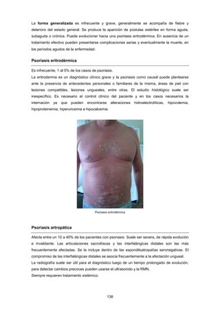 La forma generalizada es infrecuente y grave, generalmente se acompaña de fiebre y
deterioro del estado general. Se produce la aparición de pústulas estériles en forma aguda,
subaguda o crónica. Puede evolucionar hacia una psoriasis eritrodérmica. En ausencia de un
tratamiento efectivo pueden presentarse complicaciones serias y eventualmente la muerte, en
los períodos agudos de la enfermedad.
Psoriasis eritrodérmica
Es infrecuente, 1 al 5% de los casos de psoriasis.
La eritrodermia es un diagnóstico clínico grave y la psoriasis como causal puede plantearse
ante la presencia de antecedentes personales o familiares de la misma, áreas de piel con
lesiones compatibles, lesiones ungueales, entre otras. El estudio histológico suele ser
inespecífico. Es necesario el control clínico del paciente y en los casos necesarios la
internación ya que pueden encontrarse alteraciones hidroelectrolíticas, hipovolemia,
hipoproteinemia, hiperuricemia e hipocalcemia.
Psoriasis eritrodérmica
Psoriasis artropática
Afecta entre un 10 a 40% de los pacientes con psoriasis. Suele ser severa, de rápida evolución
e invalidante. Las articulaciones sacroilíacas y las interfalángicas distales son las más
frecuentemente afectadas. Se la incluye dentro de las espondiloatropatías seronegativas. El
compromiso de las interfalángicas distales se asocia frecuentemente a la afectación ungueal.
La radiografía suele ser útil para el diagnóstico luego de un tiempo prolongado de evolución,
para detectar cambios precoces pueden usarse el ultrasonido y la RMN.
Siempre requieren tratamiento sistémico.
138
 