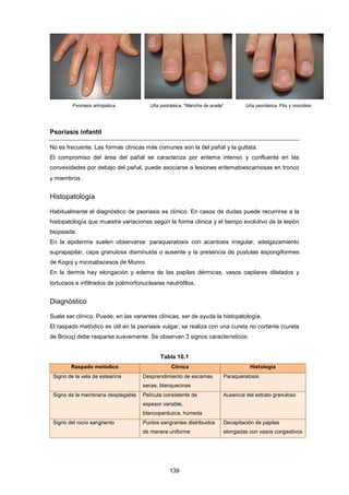 Psoriasis artropática Uña psoriásica. “Mancha de aceite” Uña psoriásica. Pits y onicolisis
Psoriasis infantil
No es frecuente. Las formas clínicas más comunes son la del pañal y la guttata.
El compromiso del área del pañal se caracteriza por eritema intenso y confluente en las
convexidades por debajo del pañal, puede asociarse a lesiones eritematoescamosas en tronco
y miembros.
Histopatología
Habitualmente el diagnóstico de psoriasis es clínico. En casos de dudas puede recurrirse a la
histopatología que muestra variaciones según la forma clínica y el tiempo evolutivo de la lesión
biopsiada.
En la epidermis suelen observarse: paraqueratosis con acantosis irregular, adelgazamiento
suprapapilar, capa granulosa disminuida o ausente y la presencia de pústulas espongiformes
de Kogoj y microabscesos de Munro.
En la dermis hay elongación y edema de las papilas dérmicas, vasos capilares dilatados y
tortuosos e infiltrados de polimorfonucleares neutrófilos.
Diagnóstico
Suele ser clínico. Puede, en las variantes clínicas, ser de ayuda la histopatología.
El raspado metódico es útil en la psoriasis vulgar, se realiza con una cureta no cortante (cureta
de Brocq) debe rasparse suavemente. Se observan 3 signos característicos:
Tabla 10.1
Raspado metódico Clínica Histología
Signo de la vela de estearina Desprendimiento de escamas
secas, blanquecinas
Paraqueratosis
Signo de la membrana desplegable Película consistente de
espesor variable,
blancoparduzca, húmeda
Ausencia del estrato granuloso
Signo del rocío sangriento Puntos sangrantes distribuidos
de manera uniforme
Decapitación de papilas
elongadas con vasos congestivos
139
 