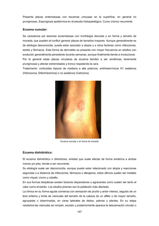 Presenta placas eritematosas con escamas untuosas en la superficie, en general no
pruriginosas. Espongiosis epidérmica en el estudio histopatológico. Curso crónico recurrente.
Eccema numular:
Se caracteriza por lesiones eccematosas con morfología discoide o en forma y tamaño de
moneda, que pueden al confluir generar placas de tamaños mayores. Aunque generalmente es
de etiología desconocida, puede estar asociado a atopia y a otros factores como infecciones,
estrés y fármacos. Esta forma de dermatitis se presenta con mayor frecuencia en adultos con
evolución generalmente persistente durante semanas, aunque finalmente tiende a involucionar.
Por lo general estas placas circulares de eccema tienden a ser simétricas, levemente
pruriginosas y afectar extremidades y tronco respetando la cara.
Tratamiento: corticoides tópicos de mediana a alta potencia, antihistamínicos H1 sedativos
(Hidroxicina, Difenhidramina) o no sedativos (Cetirizina).
Eccema numular o en forma de moneda
Eccema dishidrótico:
El eccema dishidrótico o dishidrosis, entidad que suele afectar de forma simétrica a ambas
manos y/o pies, tiende a ser recurrente.
Su etiología suele ser desconocida, aunque puede estar relacionado con atopia y reacciones
segundas o a distancia de infecciones, fármacos o alergenos, estos últimos suelen ser metales
como níquel, cromo y cobalto.
En sus formas idiopáticas existen factores disparadores o agravantes como suelen ser tanto el
calor como el estrés. Los adultos jóvenes son la población más afectada.
La clínica en su forma aguda comienza con sensación de prurito y ardor intenso, seguido de un
leve eritema y brote de vesículas del tamaño de la cabeza de un alfiler o de mayor tamaño,
agrupadas o diseminadas, en caras laterales de dedos, palmas y plantas. En su etapa
resolutiva las vesículas se rompen, exudan y posteriormente aparece la descamación circular o
147
 