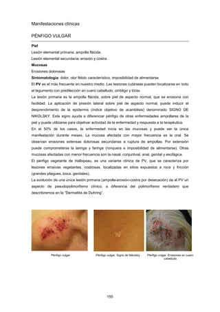 Manifestaciones clínicas
PÉNFIGO VULGAR
Piel
Lesión elemental primaria: ampolla flácida.
Lesión elemental secundaria: erosión y costra.
Mucosas
Erosiones dolorosas
Sintomatología: dolor, olor fétido característico, imposibilidad de alimentarse.
El PV es el más frecuente en nuestro medio. Las lesiones cutáneas pueden localizarse en todo
el tegumento con predilección en cuero cabelludo, ombligo y tórax.
La lesión primaria es la ampolla flácida, sobre piel de aspecto normal, que se erosiona con
facilidad. La aplicación de presión lateral sobre piel de aspecto normal, puede inducir el
desprendimiento de la epidermis (índice objetivo de acantólisis) denominado SIGNO DE
NIKOLSKY. Este signo ayuda a diferenciar pénfigo de otras enfermedades ampollares de la
piel y puede utilizarse para objetivar actividad de la enfermedad y respuesta a la terapéutica.
En el 50% de los casos, la enfermedad inicia en las mucosas y puede ser la única
manifestación durante meses. La mucosa afectada con mayor frecuencia es la oral. Se
observan erosiones extensas dolorosas secundarias a ruptura de ampollas. Por extensión
puede comprometerse la laringe y faringe (ronquera e imposibilidad de alimentarse). Otras
mucosas afectadas con menor frecuencia son la nasal, conjuntival, anal, genital y esofágica.
El pénfigo vegetante de Hallopeau, es una variante clínica de PV, que se caracteriza por
lesiones erosivas vegetantes, costrosas, localizadas en sitios expuestos a roce y fricción
(grandes pliegues, boca, genitales).
La evolución de una única lesión primaria (ampolla-erosión-costra por desecación) da al PV un
aspecto de pseudopolimorfismo clínico, a diferencia del polimorfismo verdadero que
describiremos en la “Dermatitis de Duhring”.
Pénfigo vulgar Pénfigo vulgar. Signo de Nikolsky Pénfigo vulgar. Erosiones en cuero
cabelludo
155
 
