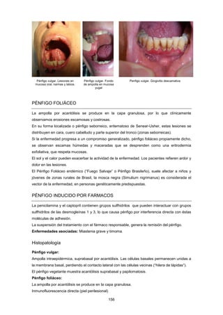 Pénfigo vulgar. Lesiones en
mucosa oral, narinas y labios.
Pénfigo vulgar. Fondo
de ampolla en mucosa
yugal
Penfigo vulgar. Gingivitis descamativa
PÉNFIGO FOLIÁCEO
La ampolla por acantólisis se produce en la capa granulosa, por lo que clínicamente
observamos erosiones escamosas y costrosas.
En su forma localizada o pénfigo seborreico, eritematoso de Senear-Usher, estas lesiones se
distribuyen en cara, cuero cabelludo y parte superior del tronco (zonas seborreicas).
Si la enfermedad progresa a un compromiso generalizado, pénfigo foliáceo propiamente dicho,
se observan escamas húmedas y maceradas que se desprenden como una eritrodermia
exfoliativa, que respeta mucosas.
El sol y el calor pueden exacerbar la actividad de la enfermedad. Los pacientes refieren ardor y
dolor en las lesiones.
El Pénfigo Foliáceo endémico (“Fuego Salvaje” o Pénfigo Brasileño), suele afectar a niños y
jóvenes de zonas rurales de Brasil, la mosca negra (Simulium nigrimanus) es considerada el
vector de la enfermedad, en personas genéticamente predispuestas.
PÉNFIGO INDUCIDO POR FARMACOS
La penicilamina y el captopril contienen grupos sulfhidrilos que pueden interactuar con grupos
sulfhidrilos de las desmogleínas 1 y 3, lo que causa pénfigo por interferencia directa con éstas
moléculas de adhesión.
La suspensión del tratamiento con el fármaco responsable, genera la remisión del pénfigo.
Enfermedades asociadas: Miastenia grave y timoma.
Histopatología
Pénfigo vulgar:
Ampolla intraepidérmica, suprabasal por acantólisis. Las células basales permanecen unidas a
la membrana basal, perdiendo el contacto lateral con las células vecinas (“hilera de lápidas”).
El pénfigo vegetante muestra acantólisis suprabasal y papilomatosis.
Pénfigo foliáceo:
La ampolla por acantólisis se produce en la capa granulosa.
Inmunofluorescencia directa (piel perilesional)
156
 