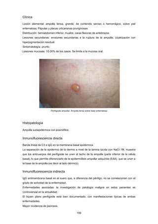 Clínica
Lesión elemental: ampolla tensa, grande, de contenido seroso o hemorrágico, sobre piel
eritematosa. Pápulas y placas urticarianas pruriginosas.
Distribución: hemiabdomen inferior, muslos, caras flexoras de antebrazos.
Lesiones secundarias: erosiones secundarias a la ruptura de la ampolla, cicatrización con
hiperpigmentación residual.
Sintomatología: prurito.
Lesiones mucosas: 10-30% de los casos. Se limita a la mucosa oral.
Penfigoide ampollar. Ampolla tensa sobre base eritematosa
Histopatología
Ampolla subepidérmica con eosinófilos.
Inmunofluorescencia directa
Banda lineal de C3 e IgG en la membrana basal epidérmica.
La separación de la epidermis de la dermis a nivel de la lamina lúcida con NaCl 1M, muestra
que los anticuerpos del penfigoide se unen al techo de la ampolla (parte inferior de la célula
basal), lo que permite diferenciarlo de la epidermólisis ampollar adquirida (EAA), que se unen a
la base de la ampolla (es decir al lado dérmico).
Inmunofluorescencia indirecta
IgG antimembrana basal en el suero que, a diferencia del pénfigo, no se correlacionan con el
grado de actividad de la enfermedad.
Enfermedades asociadas: la investigación de patología maligna en estos pacientes es
controversial en la actualidad.
El liquen plano penfigoide está bien documentado, con manifestaciones típicas de ambas
enfermedades.
Mayor incidencia de psoriasis.
159
 
