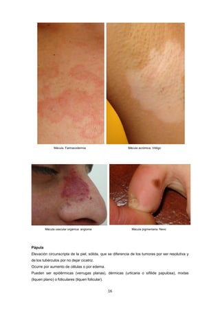 Mácula. Farmacodermia Mácula acrómica. Vitiligo
Mácula vascular orgánica: angioma Mácula pigmentaria. Nevo
Pápula
Elevación circunscripta de la piel, sólida, que se diferencia de los tumores por ser resolutiva y
de los tubérculos por no dejar cicatriz.
Ocurre por aumento de células o por edema.
Pueden ser epidérmicas (verrugas planas), dérmicas (urticaria o sifilide papulosa), mixtas
(liquen plano) o foliculares (liquen folicular).
16
 