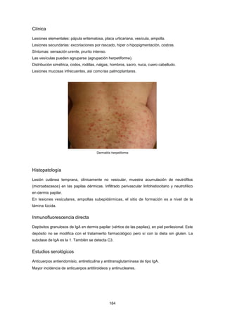 Clínica
Lesiones elementales: pápula eritematosa, placa urticariana, vesícula, ampolla.
Lesiones secundarias: excoriaciones por rascado, hiper o hipopigmentación, costras.
Síntomas: sensación urente, prurito intenso.
Las vesículas pueden agruparse (agrupación herpetiforme).
Distribución simétrica, codos, rodillas, nalgas, hombros, sacro, nuca, cuero cabelludo.
Lesiones mucosas infrecuentes, así como las palmoplantares.
Dermatitis herpetiforme
Histopatología
Lesión cutánea temprana, clínicamente no vesicular, muestra acumulación de neutrófilos
(microabscesos) en las papilas dérmicas. Infiltrado perivascular linfohistiocitario y neutrofílico
en dermis papilar.
En lesiones vesiculares, ampollas subepidérmicas, el sitio de formación es a nivel de la
lámina lúcida.
Inmunofluorescencia directa
Depósitos granulosos de IgA en dermis papilar (vértice de las papilas), en piel perilesional. Este
depósito no se modifica con el tratamiento farmacológico pero sí con la dieta sin gluten. La
subclase de IgA es la 1. También se detecta C3.
Estudios serológicos
Anticuerpos antiendomisio, antireticulina y antitransglutaminasa de tipo IgA.
Mayor incidencia de anticuerpos antitiroideos y antinucleares.
164
 